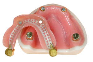 磁铁式精密附着体-龙腾义齿